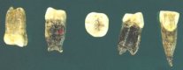 Peking Man teeth unearthed from 1949 to 1951