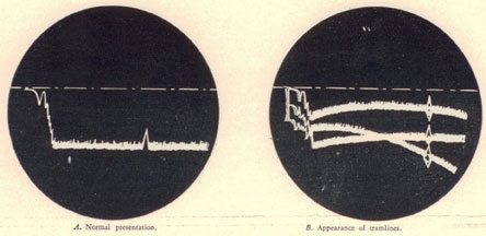 A. Normal presentation B. Appearance of tramlines.