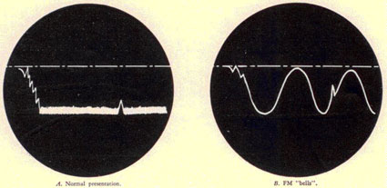 A. Normal presentation. B. FM 'bells'.