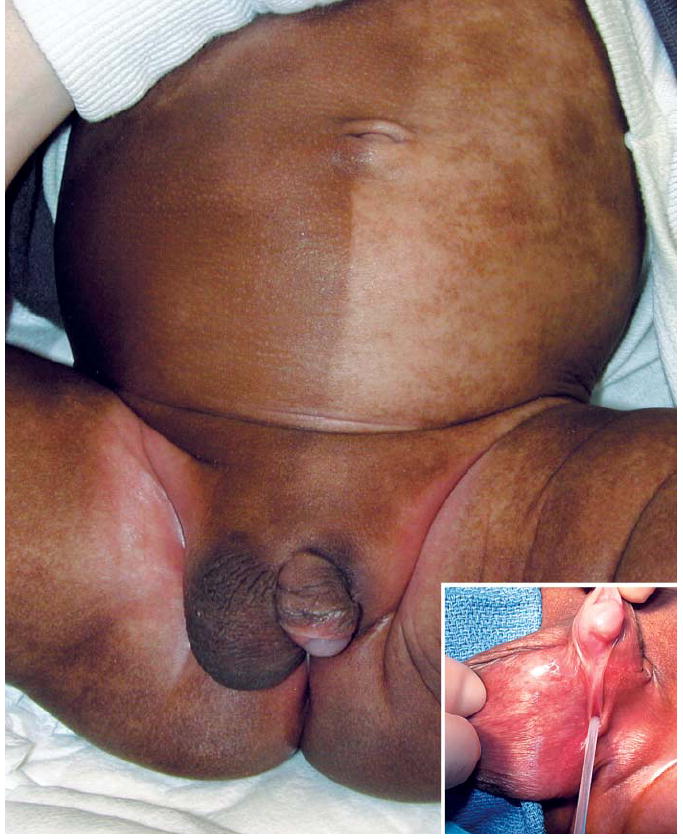 NEJM Volume 350(4) 22 January 2004 p 393 True Hermaphroditism Images in Cli...